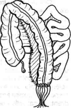 28- Coborârea în pelvis a colonului stâng restant păstrându-se poziţia anatomică normală a acestuia respectiv la stânga mezenterului şi anselor intestinale subţiri.
