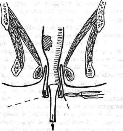 150 ----- Chirurgia colonului, rectului şi canalului anal Fig. 5.33 - Bujia imaginată de A.