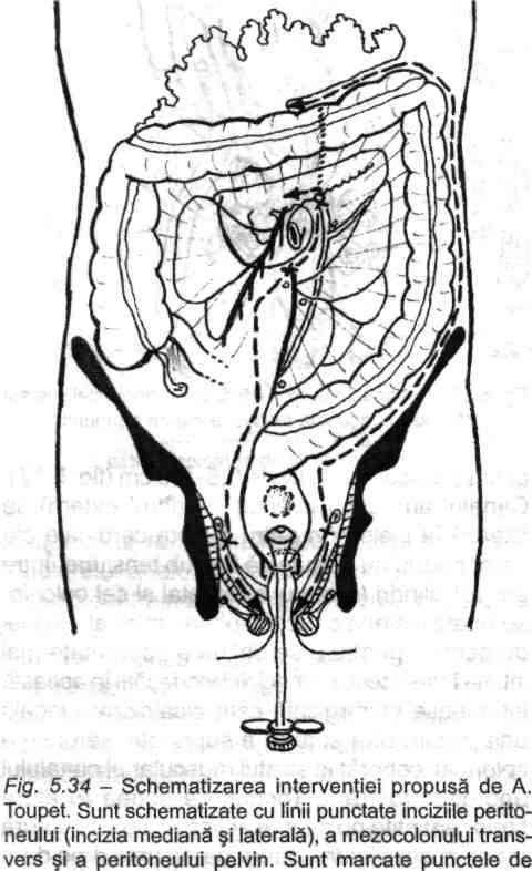 Chirurgia de exereză rectală (colorectală) Fig. 5.35- Continuare la fig. 5.34. Timpul de răsturnare a rectului cu ajutorul bujiei A. Toupet şi secţiunea rectului. intercepţie a arterelor. anale.