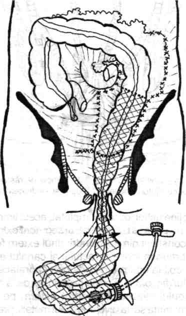 152 Chirurgia colonului, rectului şi canalului anal ^l l I ) Fig. 5.37- Continuare la fig. 5.36. Canalul anorectal eversat este fixat în această poziţie la pielea perineului. Fig. 5.36 - Continuare la fig.