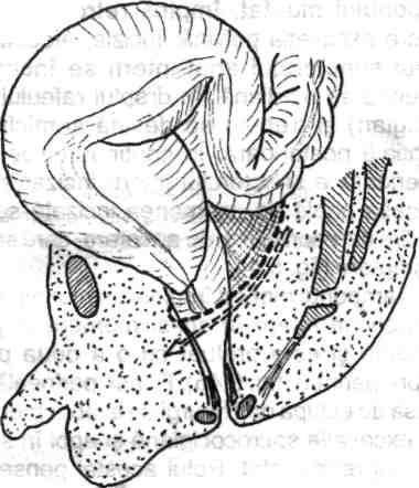 Chirurgia de exereză rectală (colorectală) tene- Fig. 5.40- Operaţia B. Duhamel. Incizia intraabdominală a bazei mezosigmoidului şi interceptarea vaselor sigmoidiene.
