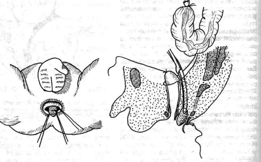 marginea posterioară şi inferioară, mucocutanată, a canalului anal (fig. 5.43). Timpul perineal.