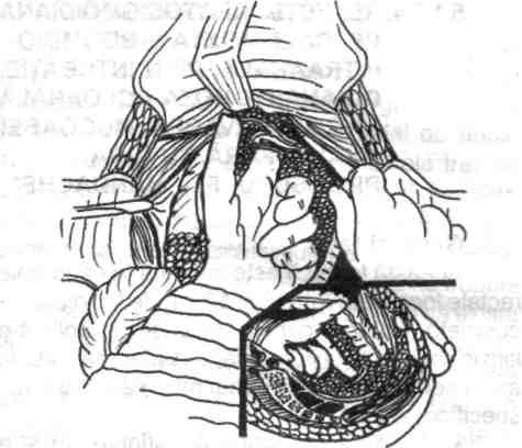 în context se ligaturează şi secţionează ligamentul rectosacrat (porţiunea caudală a mezo-rectului), la distanţă de inserţia sa pe faţa anterioară a sacrului.