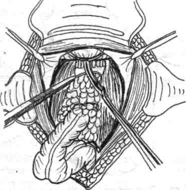 Fig. 5.66- Ligatura-secţionarea ligamentului recto-sacrat. suficientă a ansei este apreciată dacă, pliind ansa preparată la mijlocul ei, bucla respectivă atinge cu uşurinţă simfiza pubiană.