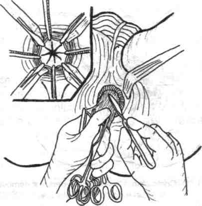 Chirurgia de exereză rectală (colorectală) 167 Pentru a se efectua incizia mucoasei anorectale astfel reperate se aplică un al doilea rând de pense, vis-a-vis şi cranial de primele (fig. 5.68).