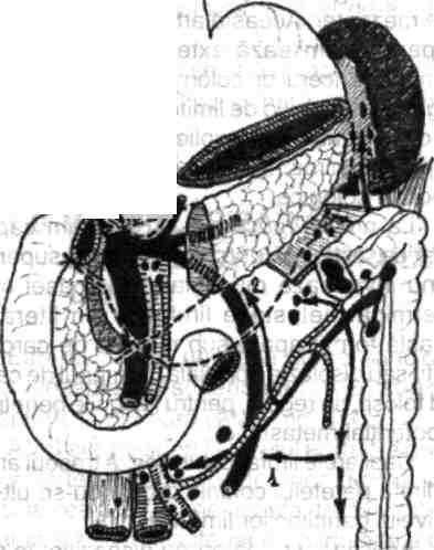 's^jalu-.b Chirurgia colonului, rectului şi canalului anal sp«t Fig. 1.14 - Ganglioni limfatici ai cadrului colic.