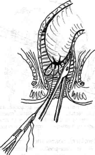 Tracţiunea blândă pe firele de ligatura uşurează o disecţie proximală, adiţională, pentru efectuarea mucosectomiei deasupra canalului anal. Fig. 5.