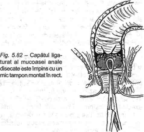Incizie circumferenţială a muco-submucoasei proximal de linia dinţată (cranial de sfincterul intern). Fig. 5.