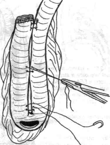 87 - Poziţionarea sfap/er-ului linear cutter pentru sutura-anastomoza celor două braţe ale ansei ileale care vor constitui rezervorul în J". Fig. 5.
