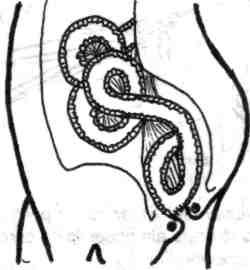 Constă în construirea unui inel ileal (fără ca picioarele ansei care constituie inelul să comunice) care se anastomozează la canalul anal tot printr-o anastomoză latero-terminală (fig. 5.