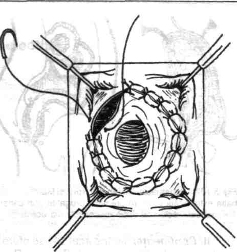 105); firele înnodate se păstrează pe pense şi se secţionează când sutura este terminată; la sfârşit, odată cu secţiunea firelor, linia de sutură se entropionează puţin, de obicei spontan, ceea ce