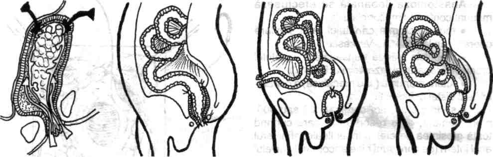 Chirurgia colonului, rectului şi canalului anal Fig. 5.