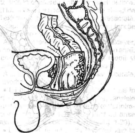dependentă de vârstă, sex, înălţime etc), rectul are originea conform anatomiştilor unui plan corespunzător corpului vertebral S3 (fig. 1.16).