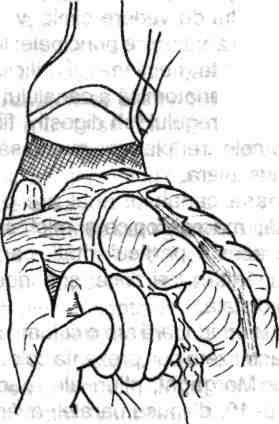 Anatomia chirurgicală a colonului, apendicelui, rectului şi canalului anal 23 Fig. 1.20 - Reprezentare schematică a dispozitivelor fasciale rectale.