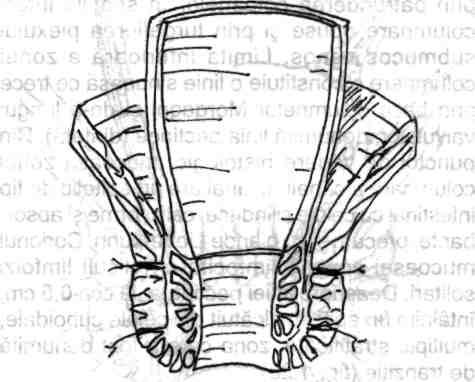 Chirurgia colonului, rectului şi canalului anal în submucoasă două spaţii virtuale capabile de distensie: spaţiul circumanal superior sau submucos, corespunzător zonei columnare şi spaţiul perianal