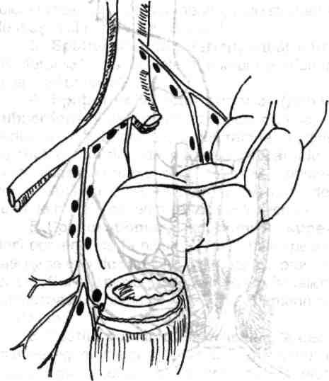 dinţate, întâlnim trei pachete hemoroidale principale (interne sau superioare) corespunzătoare orelor 3,7,11 în poziţia taliei hipogastrice (decubit dorsal), care drenează în venele hemoroidale