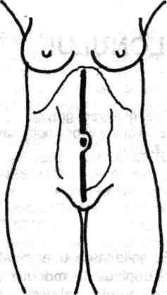 38 Chirurgia colonului, rectului şi canalului anal Fig. 3.1 - Incizie mediană xifopubiană. Fig. 3.2- Incizia Jalaquier. Fig. 3.3 - Incizia Roux-Carcassorte.