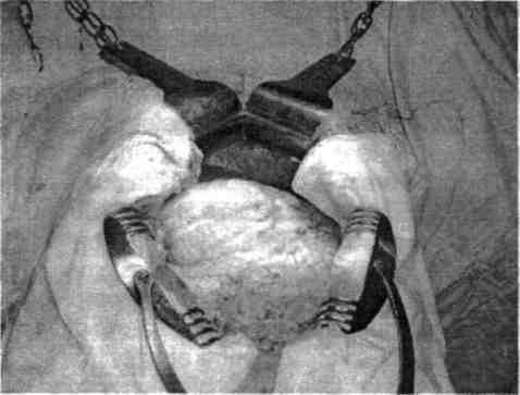 Chirurgia colonului, rectului şi canalului anal Fig. 4.2 - Hemicolectomia dreaptă - schema extensiei intervenţiei chirurgicale curent efectuate în cancerul de colon drept.