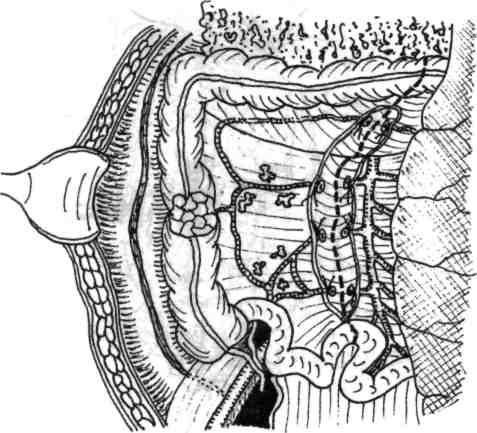 Chirurgia de exereză conservatoare colorectală 49 Fig. 4.7 - Izolarea, ligaturarea şi secţionarea pediculilor vasculari ai colonului drept (uneori inclusiv a ramurii drepte a arterei colonice drepte).
