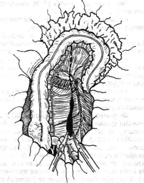 Se evidenţiază succesiv, se pensează sau se ligaturează, după care se secţionează, pediculul vascular colonie drept, pediculul vascular al unghiului colonie drept şi în funcţie de particularităţile