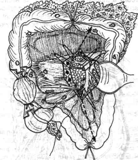 Foiţa inferioară a mezocolonului transvers se incizează vertical, în continuarea inciziei peritoneale descrise, ligaturându-se la nivelul la care va fi interceptat colonul transvers şi arcada