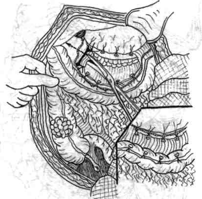 Chirurgia de exereză conservatoare colorectală Fig. 4.13- Secţiunea ligamentului gastrocolonic se execută cu hemostaza minuţioasă a tuturor vaselor incluse. Fig. 4.14 - Ligaturarea şi secţionarea parţială a ligamentului suspensor al unghiului colonie drept.