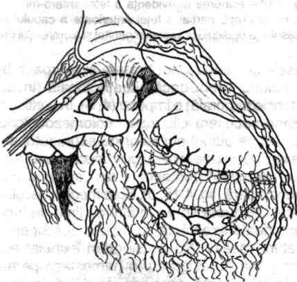 Se incizează peritoneul din firida parietocolonică dreaptă, în afara cecocolonului, la nivelul liniei albe" Toldt (fig. 4.