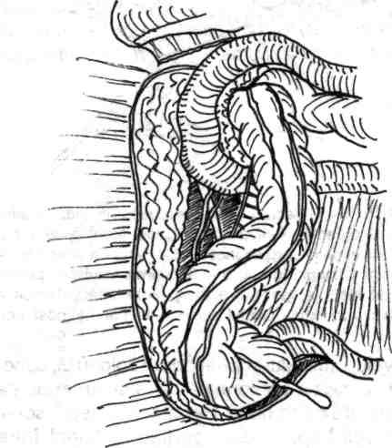 Incizia peritoneului din firida parietocolonică dreaptă efectuată în planul de clivaj retro-colonic, cât mai exact posibil este urmată de decolarea cecocolonică de sus în jos, sau invers de jos în