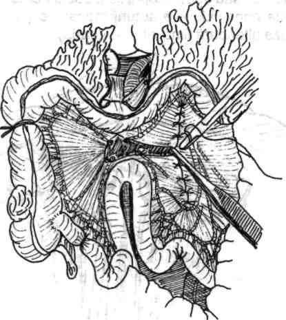 Raţiunea suturii breşei peritoneale la care ne referim în acest timp Fig. 4.19 - începerea suturii - cu puncte separate, fire resorbabile - a marginilor de secţiune ale mezocolonului şi mezenterului.
