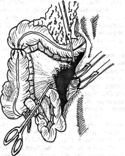 Chirurgia colonului, rectului şi canalului anal Fig. 4.22 - Secţiunea-sutura ultimei anse ileaie cu linear cutter-stapler (G/>4)f^O, Fig. 4.20 - Secţiunea ultimei anse ileaie.