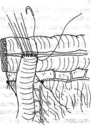 56 --------------- Chirurgia colonului, rectului şi canalului anal Fig. 4.