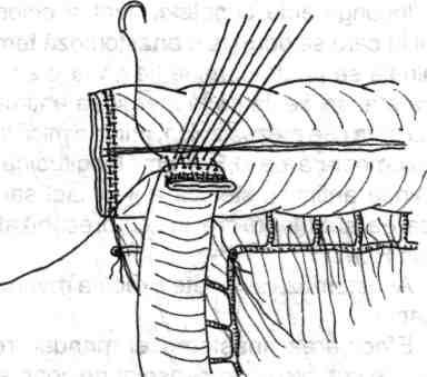 anastomozat au fost suturate-secţionate cu linear-cuter stapler, stratul sero-musculo-seros