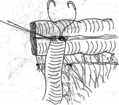 26 - Excizia extremităţii suturate a ansei ileale (la 1 cm caudal de linia de sutură mecanică a