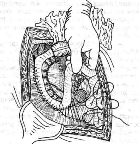 DU Fig. 4.41 - Procedura recomandată de Quenu pentru peritonizarea spaţiului retroperitoneal decolat, restant consecutiv ileo-hemicolectomiei drepte.