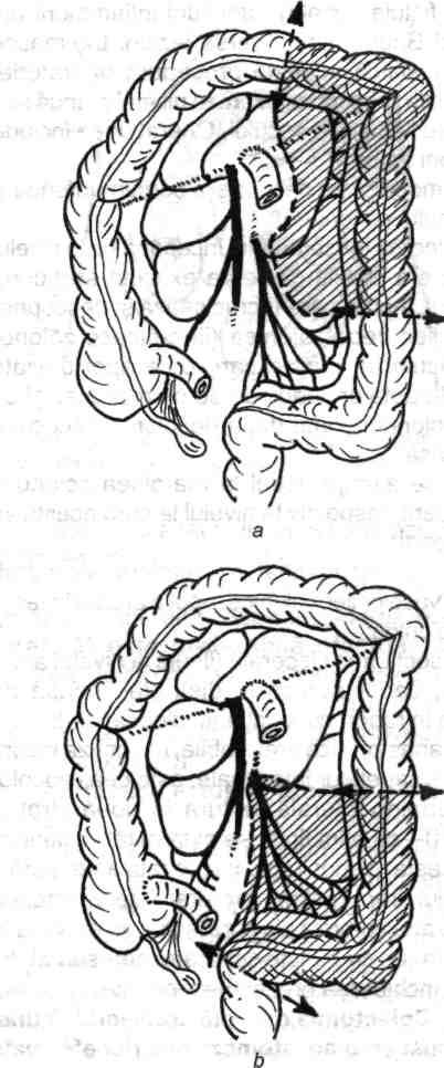 66 Chirurgia colonului, rectului şi canalului anal 4.2.2. COLECTOMIILE STÂNGI 4.2.2.1. GENERALITĂŢI în acest grup de operaţii sunt incluse rezecţi-ile totale sau parţiale ale colonului stâng.