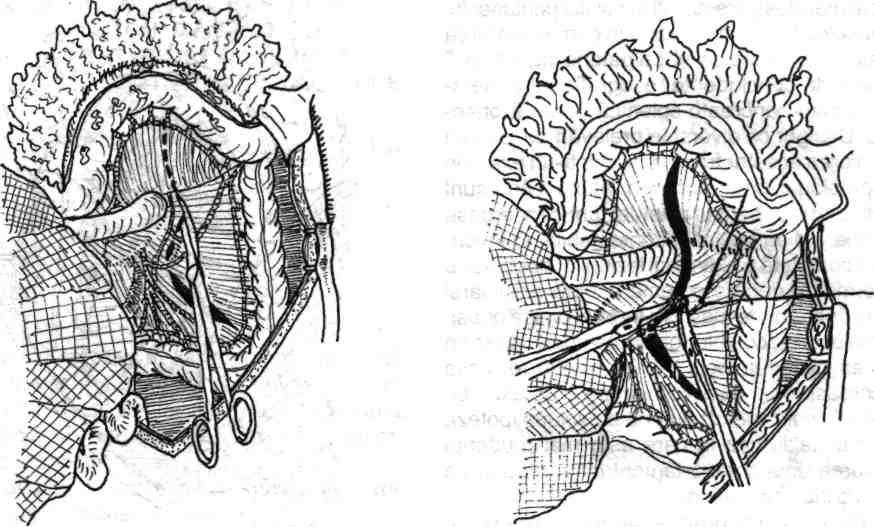 70 Chirurgia colonului, rectului şi canalului anal Fig. 4.57 - Expunerea firidei mezenterico-colonice stângi prin răsturnarea colono-mezocolonului transvers cranial peste rebordurile costale.