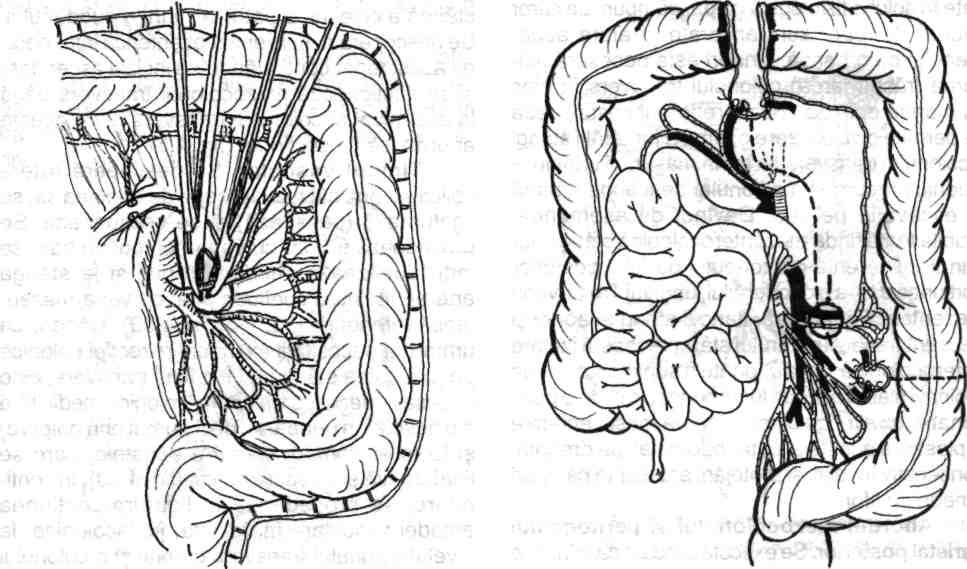 Fig. 4.59- a - Disecţia, interceptarea şi secţiunea arterei colonice stângi (superioare); b - Ligatura-secţiune a arterei sigmoidiene superioare la origine. Fig. 4.60 - Reprezentarea schematică a interceptării la origine a ramurii stângi a arterei colonice medii, precum şi secţiunea-ligatura la emergenţa lor a vaselor sigmoidiene superioare.