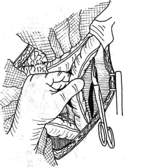 începe în porţiunea mijlocie a colonului transvers şi este continuată spre stânga până la nivelul ligamentului frenocolonic stâng.