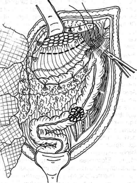 72 Chirurgia colonului, rectului şi canalului anal Fig. 4.63- Mobilizarea unghiului colonie stâng (splenic) (I) prin ligatura-secţiune a ligamentului frenocolonic stâng (sustentaculum lienis). Fig. 4.64- Mobilizarea unghiului colonie stâng (II)-detaliu.