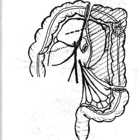 Dacă aceste condiţii nu sunt cert îndeplinite devine necesară completarea mobilizării colonului, cranial prin extensia timpului de interceptare vasculară spre dreapta precum şi lărgirea decolării