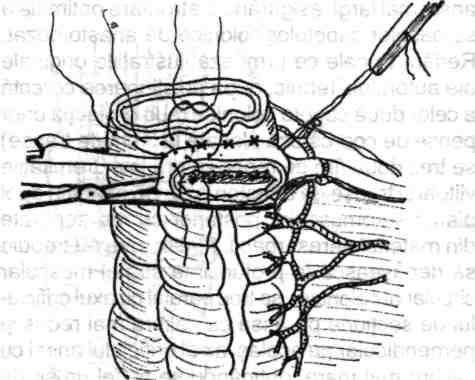 spre dreapta până la unghiul colonie drept, anastomoza între colonul ascendent prealabil mobilizat şi colonul descendent distal sau colonul sigmoidian se execută printr-o breşă practicată într-o zonă