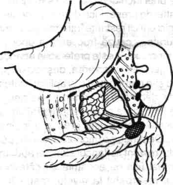 Nu este indicată fixarea marginii stângi a marelui epiploon cu fire la marginea restantă (stângă) a peritoneului.