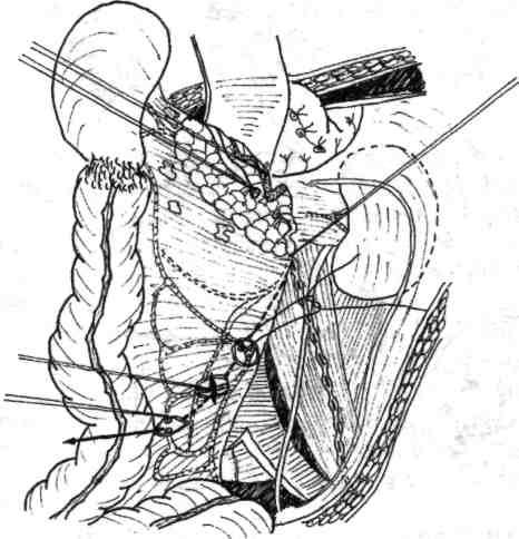 Ligatura pediculului splenic se execută pe marginea superioară a joncţiunii coadă-corp pancreatice. Secţiunea între ligaturi a venei mezenterice Fig. 4.