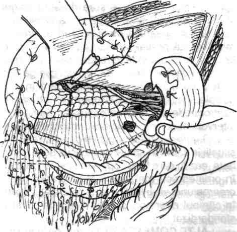 în spaţiul retroperitoneal astfel deschis devin vizibile rinichiul şi ureterul stâng, pediculul vascular genital, flancul stâng al aortei şi o parte din dispozitivul muscular pariero-abdominal