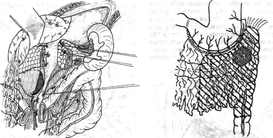80 Chirurgia colonului, rectului şi canalului anal Fig. 4.