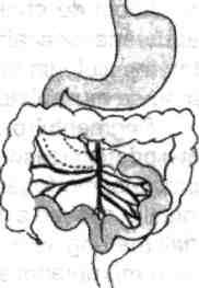 nului, apendicelui, rectului şi canalului anal 11 Fig. 7.3- Reprezentare schematică a herniei fiziologice. [diametru şi va forma viitorul colon ascendent şi!