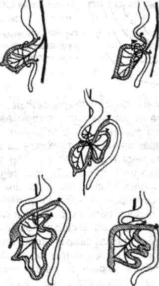 dezvolta cecul) (fig. 1.3). 2. în a doua etapă, care are loc în săptă mâna 10, intestinul herniat revine în cavitatea peritoneală, continuând mişcarea de rotaţie cu 180.