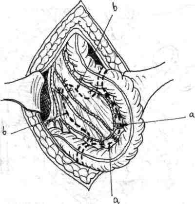 84 Chirurgia colonului, rectului şi canalului an Fig. 4.