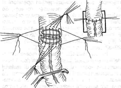 86 Chirurgia colonului, rectului şi canalului "S Fig. 4.97- Sutura cu fire separate a stratului total anterior consecutiv suturii stratului total posterior.