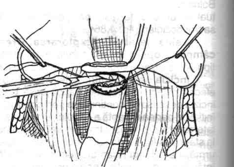 Chirurgia colonului, rectului şi canalului i recomandă aplicarea unei pense atraumatice (netriturante) în L" (tip Charrier, Michon sau Satinski în funcţie de calibrul rectului) caudal pe rect,